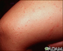 Gianotti-Crosti syndrome on the leg