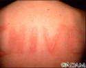 Dermatographism on the back