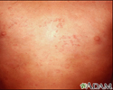 Hives (urticaria) on the chest