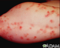 Dermatitis herpetiformis on the forearm