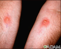 Skin testing - PPD (R arm) and Candida (L)