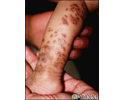 Incontinentia pigmenti on the leg