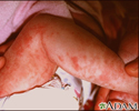 Incontinentia pigmenti on the leg