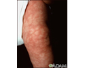 Cutis marmorata on the leg