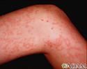 Granulomatosis with polyangiitis on the leg