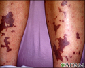 Meningococcemia on the calves