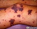 Meningococcemia on the leg