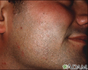 Molluscum contagiosum on the face