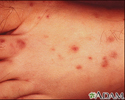 Rocky mountain spotted fever on the foot