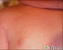 Miliaria crystallina - close-up