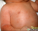 Miliaria crystallina - chest and arm