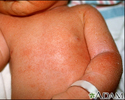 Miliaria crystallina - chest and arm