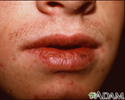 Cheilitis - actinic
