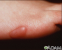 Keloid - on the foot