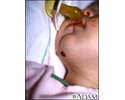 Hemangioma on the chin
