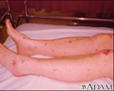 Meningococcemia associated purpura