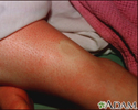 Pitting edema on the leg
