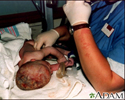Infant care following delivery