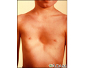 Pectus excavatum
