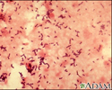 Pneumococcal pneumonia