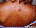 Acne on the back