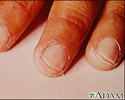 Kawasaki's disease - peeling of the fingertips