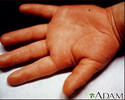 Kawasaki disease - edema of the hand