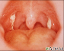 Mononucleosis - view of the throat
