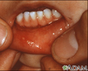 Hand, foot, and mouth disease - mouth