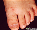 Hand, foot, and mouth disease on the foot