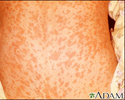 Measles on the back
