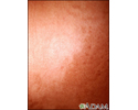 Hyperpigmentation 2