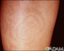 Post-inflammatory hyperpigmentation - calf