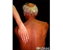 Hyperpigmentation w/malignancy
