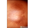 Post-inflammatory hyperpigmentation 2