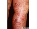 Telangiectasia - legs