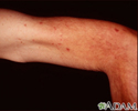 Telangiectasias - upper arm