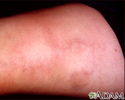 Superficial thrombophlebitis
