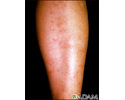 Microscopic polyarteritis 2