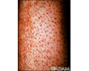 Scurvy - corkscrew hairs