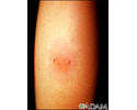Positive PPD skin test