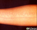 Dermatographism - arm