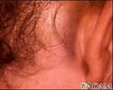 Battle's sign - behind the ear