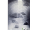 Small bowel obstruction - X-ray