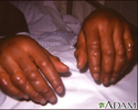 Frostbite - hands
