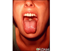 Mononucleosis - mouth