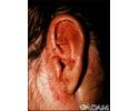 Tinea corporis - ear