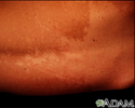 Tinea versicolor - back