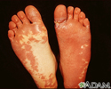 Sturge-Weber syndrome - soles of feet