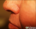 Basal cell carcinoma - nose